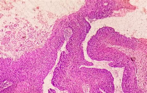 Premium Photo Photomicrograph Showing Tongue Squamous Cell Carcinoma Grade Ii Oral Invasive Scc