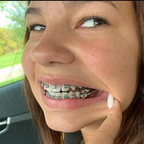 Braces Colors To Make Teeth Look Whiter