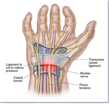 Tendon, tissue that attaches a muscle to other body parts, usually bones. THERAPY1ONE: What is Carpal Tunnel Syndrome