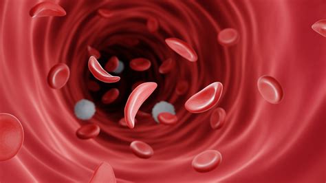 Sickle Cell Disease Explained Causes Symptoms And Treatments