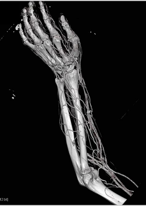 Abscess In Forearm With Cta And 3d Musculoskeletal Case Studies