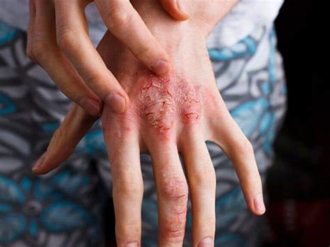 Is Eczema Contagious Causes Remedies What To Do At Home And