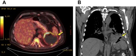 Multimodality Treatment Of Gastric Lymphoma Surgical Clinics