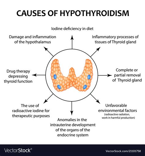 Causes Of Thyroid Hypothyroidism Infographics Vector Image