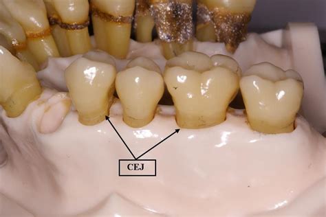 18,843 likes · 175 talking about this. Cemento-Enamel Junction (CEJ) | Dental Terminology ...