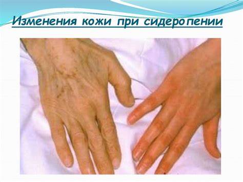 Анемия постгеморрагическая диета Клинический случай. Железодеффицитная анемия, постгеморрагическая Клинический случай. Железодеффицитная анемия, постгеморрагическая Анемия постгеморрагическая диета