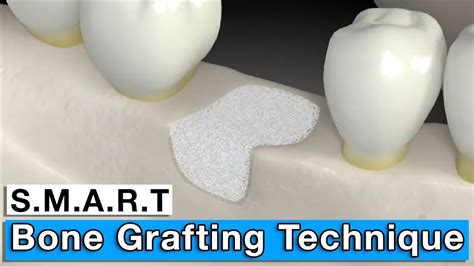 Bone Grafting Minimally Invasive Smart Bone Graft Youtube