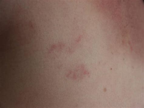 This is because the symptoms are very similar. Early Inflammatory Breast Cancer Rash Pictures : Top 10 ...