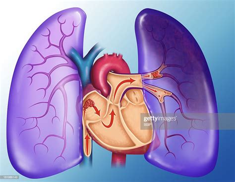 Pulmonary Embolism A Blood Clot Arrives At The Heart And Is Sent