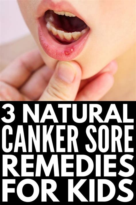 Natural and Effective: 9 Canker Sore Remedies That Work Fast | Canker