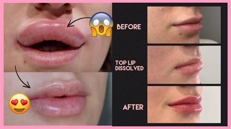 Juvederm Lips Before And After 1 Syringe