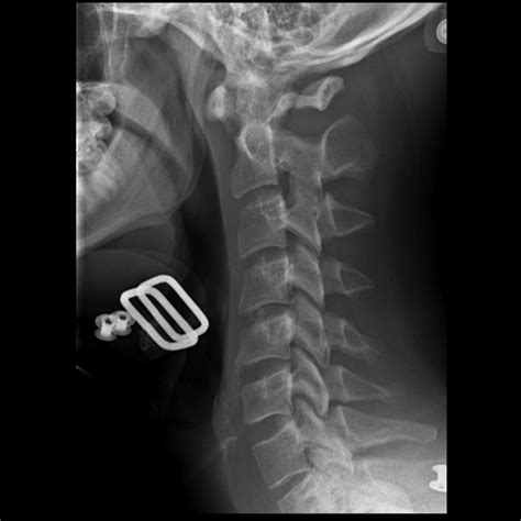 Fracture Luxation Et Entorse Du Rachis Cervical Thoracotomie