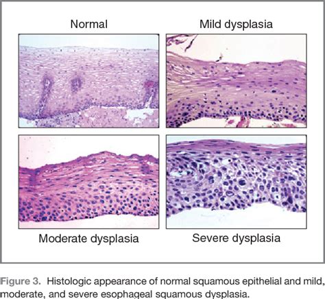 Table 2 From Squamous Dysplasia—the Precursor Lesion For Esophageal