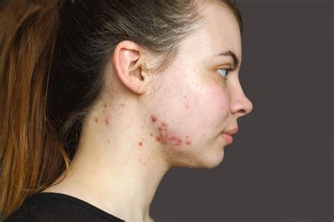 Types Of Acne Scars And How To Treat Them