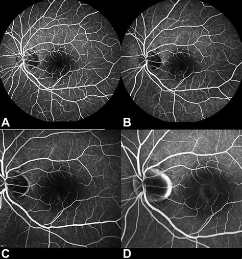 Central Serous Chorioretinopathy In A Patient Of Juxtapapillary