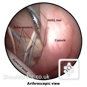 Avulsion of the ighl from the proximal humerus. HAGL Injury | ShoulderDoc