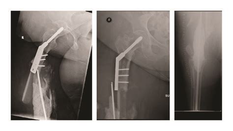 Ap And Lateral Radiographs Of Right Hip And Lateral Radiograph Of Right