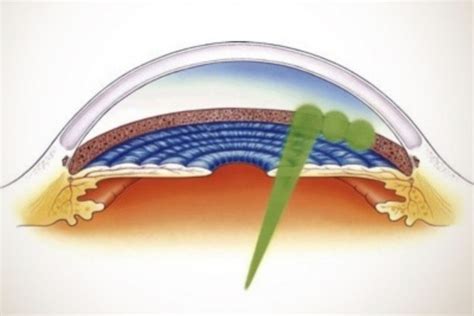 Trabeculoplastia Seletiva A Laser O Tratamento Que Pode Eliminar A