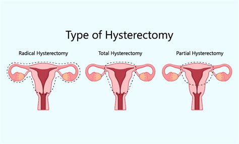 Hysterectomy Faqs
