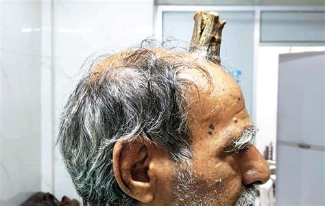 Photos Show Huge Four Inch Devil Horn Growth Removed From Mans Head