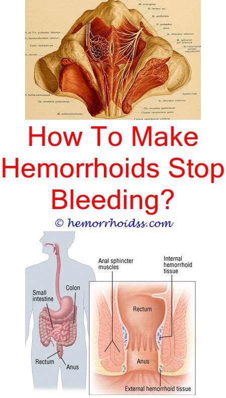 what do hemorrhoids look like on the outside cure for hemorrhoids hemorrhoid remedies