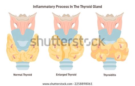 Thyroiditis Thyroid Inflammation Thyroid Gland Produces Stock Vector