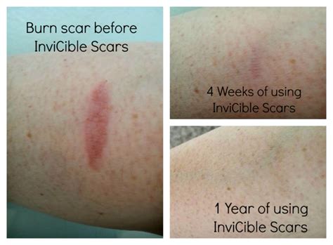How To Treat New Burn Scars Heal Info