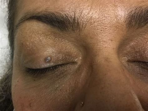 Derm Dx Asymptomatic Growth On The Eyelid Dermatology Advisor