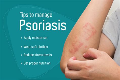 Tips To Manage Psoriasis