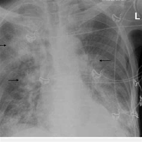 Chest Radiograph Showing Diffuse Opacification And Emphysematous