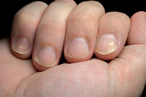 What Causes My Fingernails To Turn Purple Design Talk