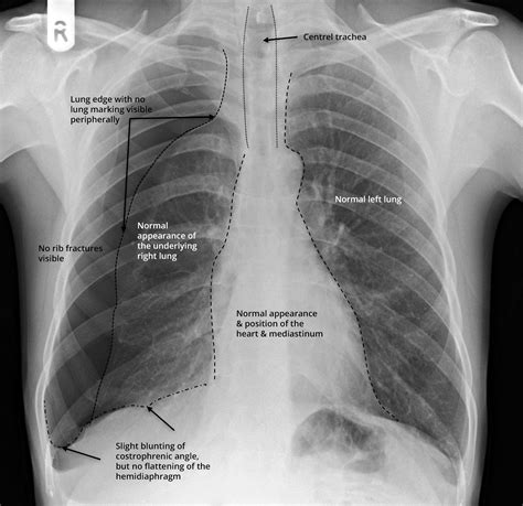 Anatomy Of Chest X Ray 15 Imaging Studies Clinicians Pocket