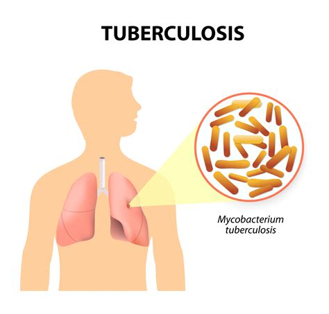 Tuberculosis Images
