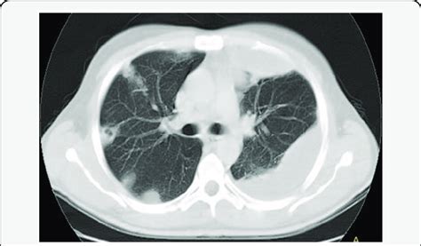 Ct Scan Of Chest With Bilateral Nodular Lung Opacities Representing