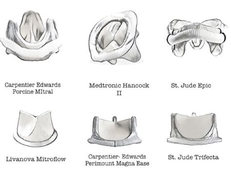 Biological Heart Valves Evolution In The First Line Mitral Prostheses