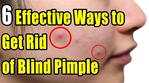 How To Get Rid Of Blind Pimple 100 Effective The Only Right Way To