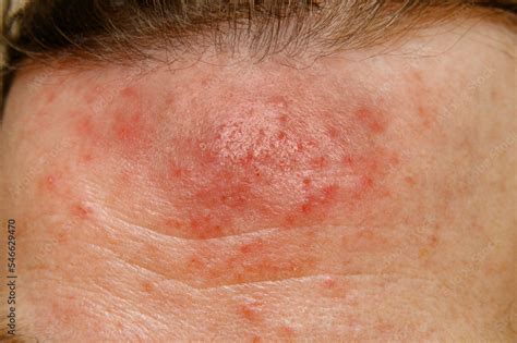 Foto Stock The Skin On The Forehead Is Affected By The Iron Mites