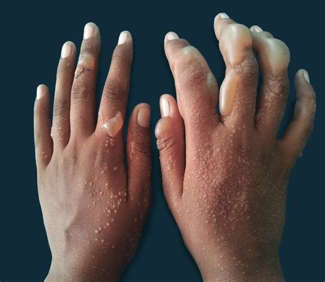 Multiple Tense Vesiculobullous Lesions On The Bilateral Dorsal Hands