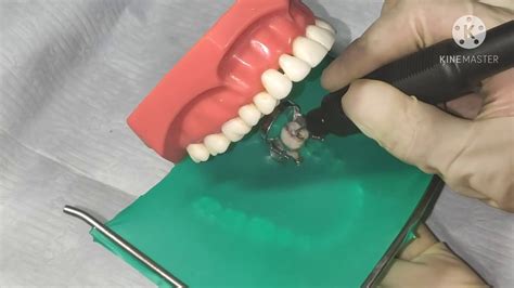 Cavidad Simple Para Amalgama Operatoria Dental Youtube