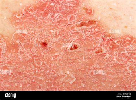 Skin Disorder Stock Photos And Skin Disorder Stock Images Alamy