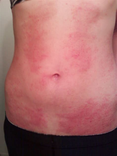 Itchy Rash On Stomach Belly Button Rash Causes And Symptoms
