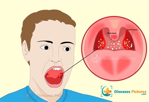Causes Of Throat Infections
