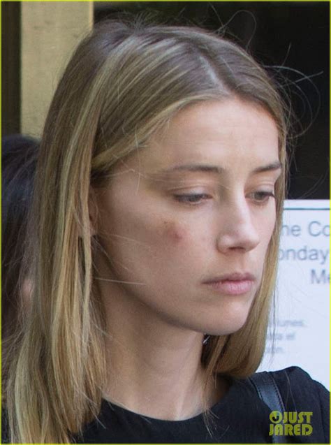 Amber Heard Leaves Court With Bruised Face Granted Restraining Order Against Johnny Depp Photo