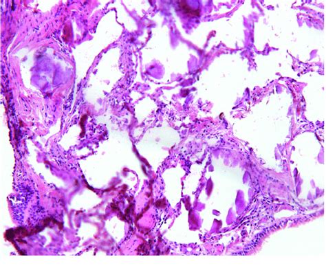 Transbronchial Lung Biopsy Images Show Alveolar Tissue Adjacent To
