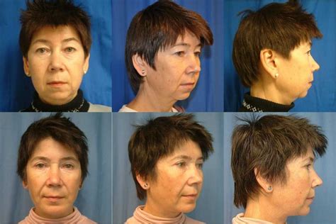 Facelift In Seattle By Top Plastic Surgeon Dr Brian Windle Dr Brian