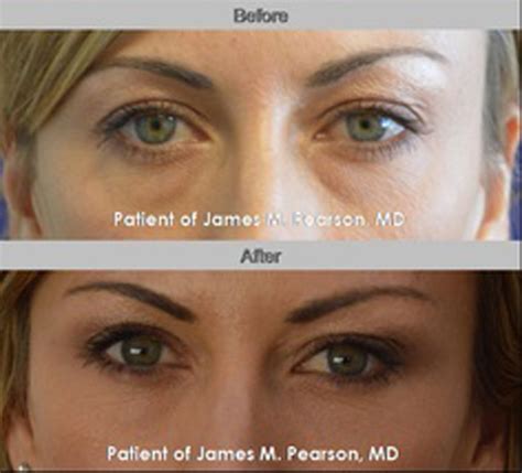 Eye Rejuvenation Photos Before And After Dr James Pearson Facial