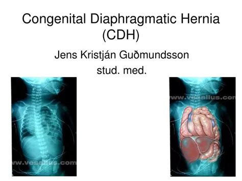 Ppt Congenital Diaphragmatic Hernia Cdh Powerpoint Presentation