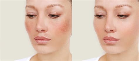 Medlite Laser Facial Ozmedica Aesthetic Skin Clinic