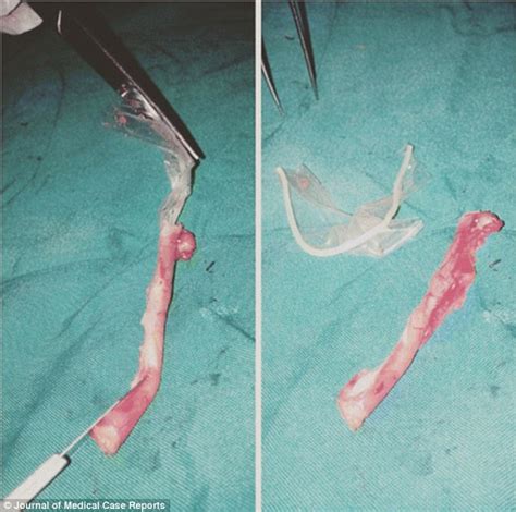 Woman Was Found To Have A Condom Stuck Inside Her Appendix Daily Mail