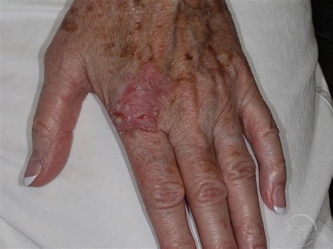 Skin Cancer Horn Malignant Lesions Of The External Periocular Tissues